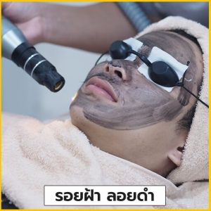 รักษารอยฝ้า-รอยดำ